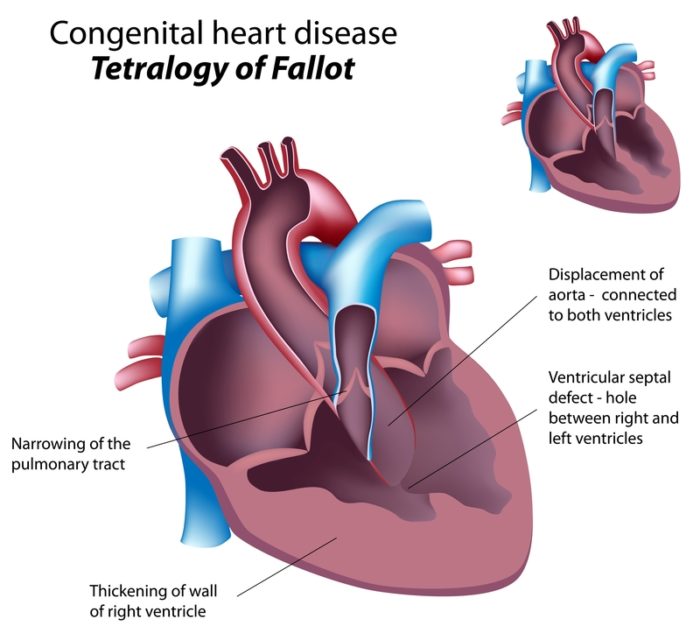 congenital heart disease e