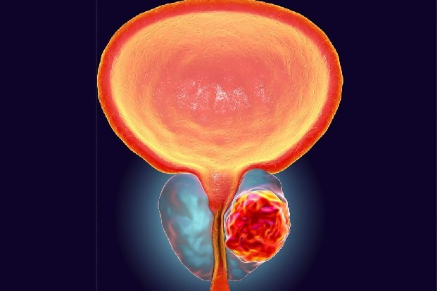 new prostate cancer treatment