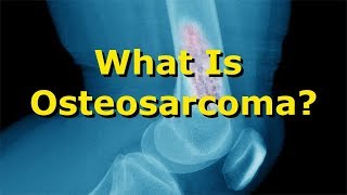 What is osteosarcoma?