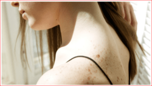 Skin Cancer Treatment and Prevention 