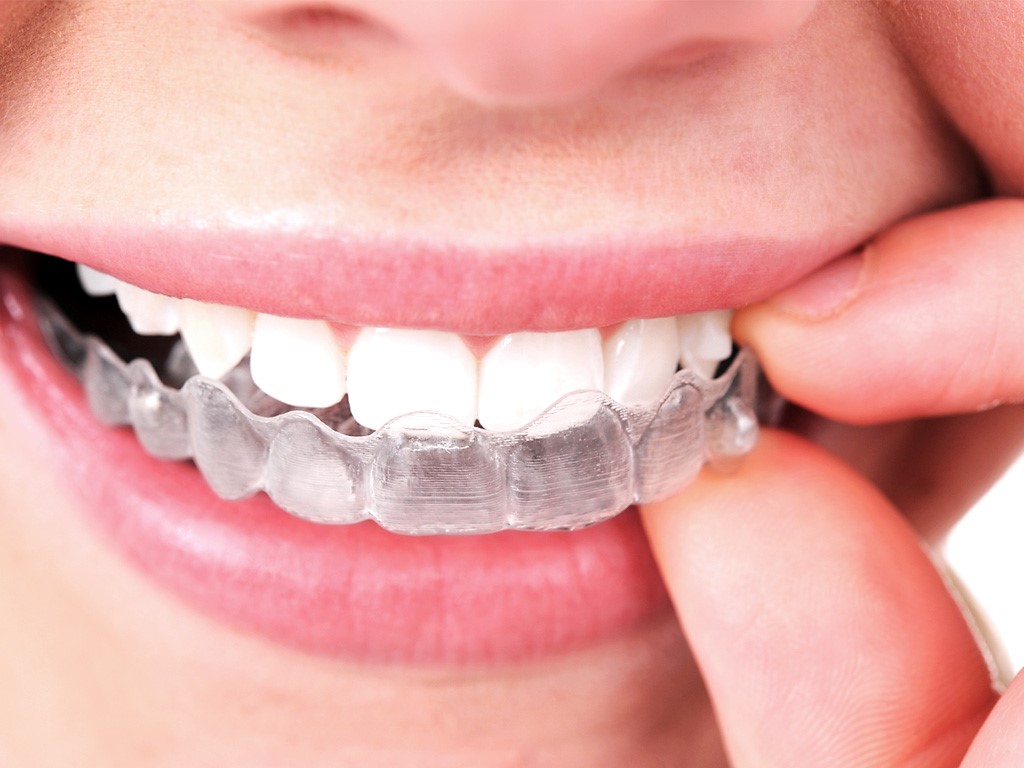 How To Make Your Smile Brighten With Invisalign?