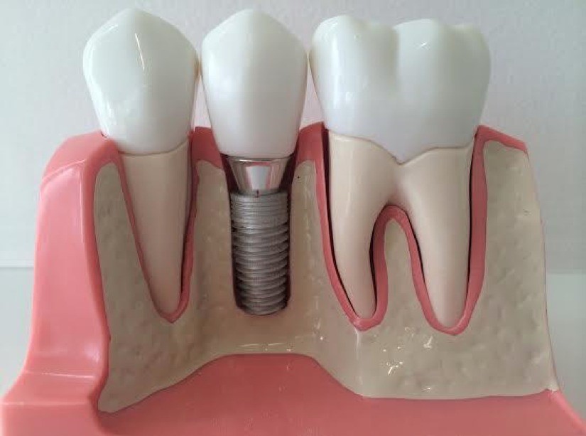 Things You Should Remember Before Getting Dental Implants?