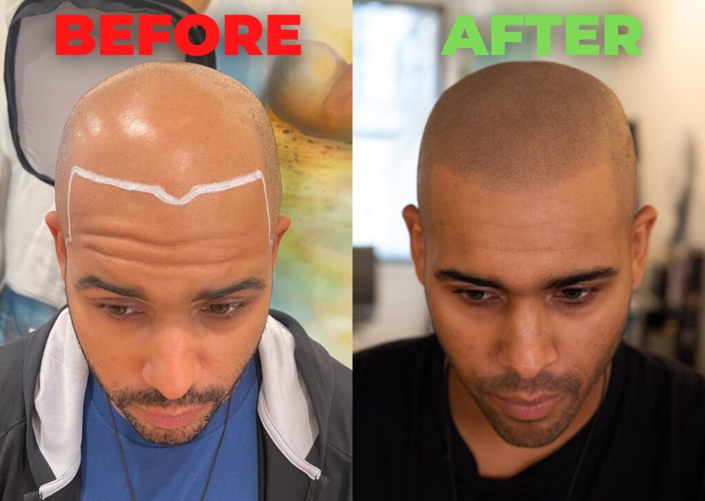 Scalp Micropigmentation