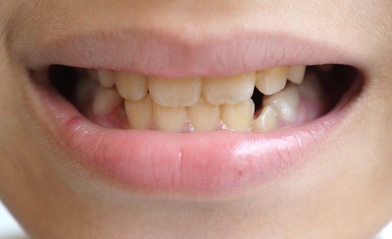 Yellowing Of Teeth In Child | Causes, Prevention, and Treatment