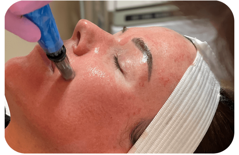 Microneedling for Acne Scars: Does It Work?