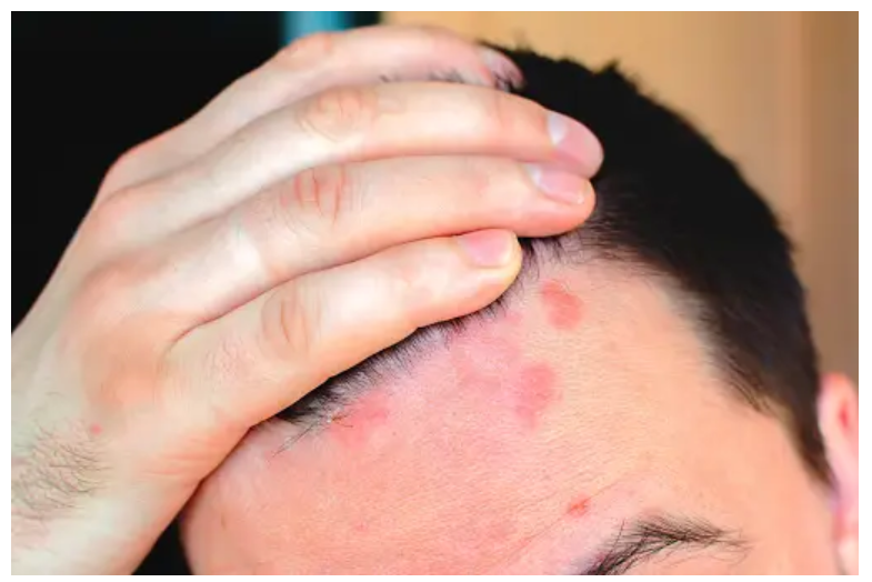 How to Cope with Psoriasis on the Scalp and Restore Hair Confidence