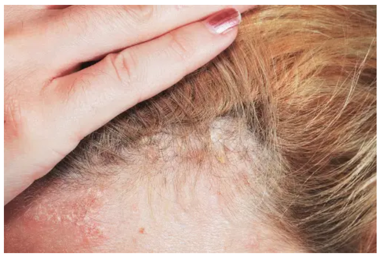How to Cope with Psoriasis on the Scalp and Restore Hair Confidence
