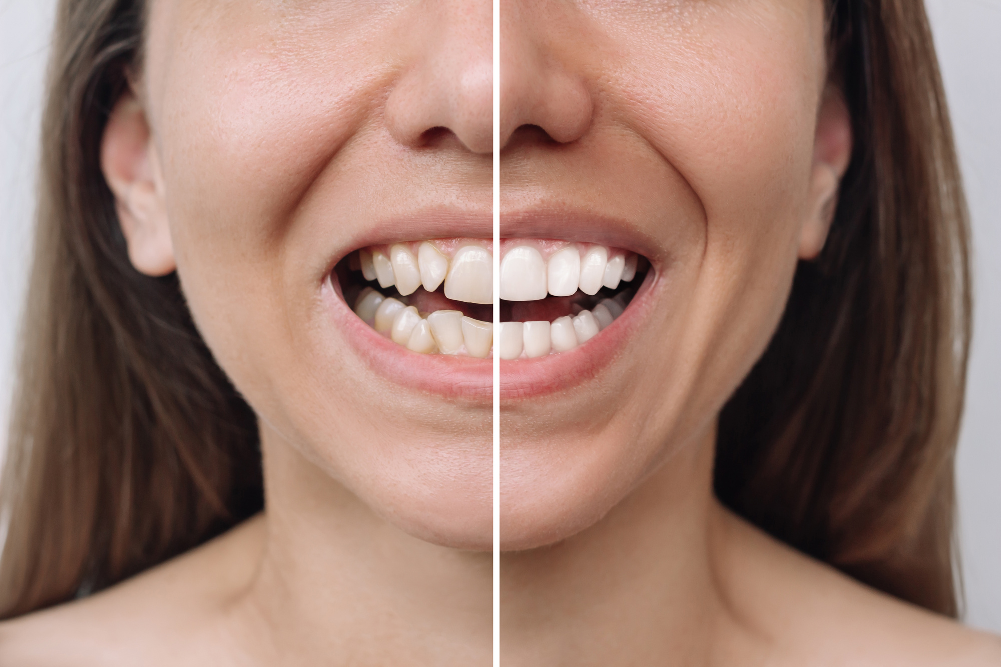 Smile Makeovers: Decoding The Best Cosmetic Dental Treatments
