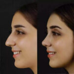 Nose Surgery in Dubai: What Makes It So Popular?