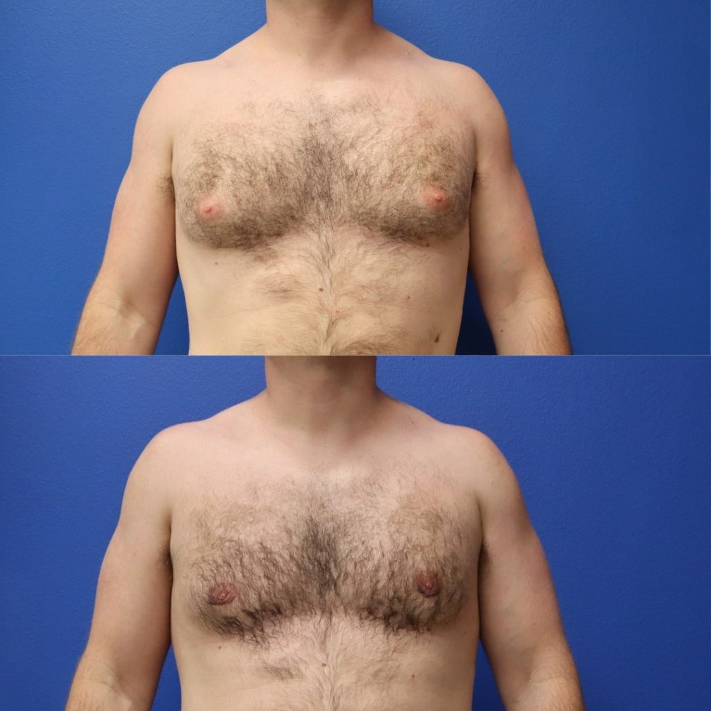 Gynecomastia Surgery in Dubai
