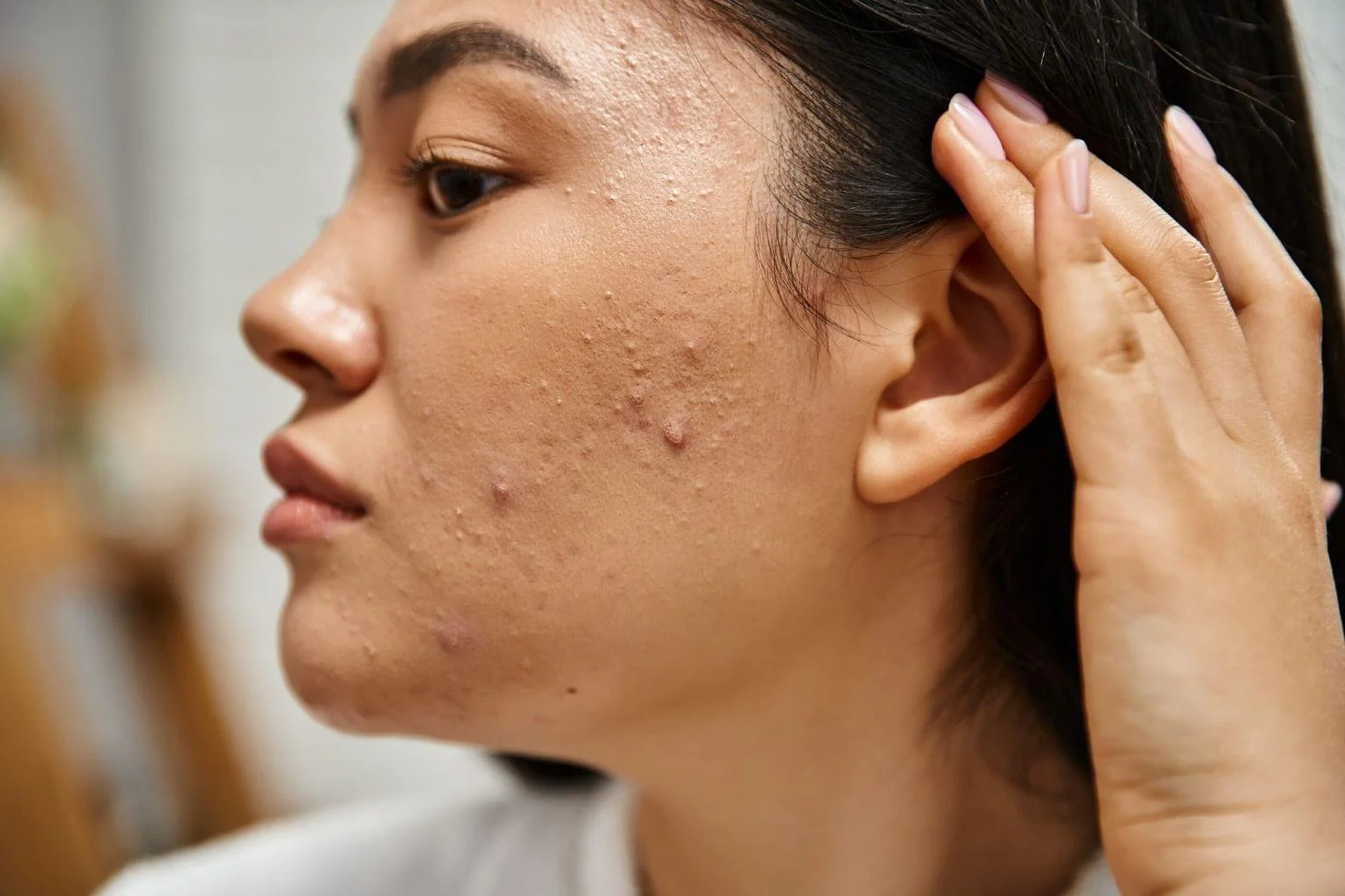 Acne Treatment in Matunga