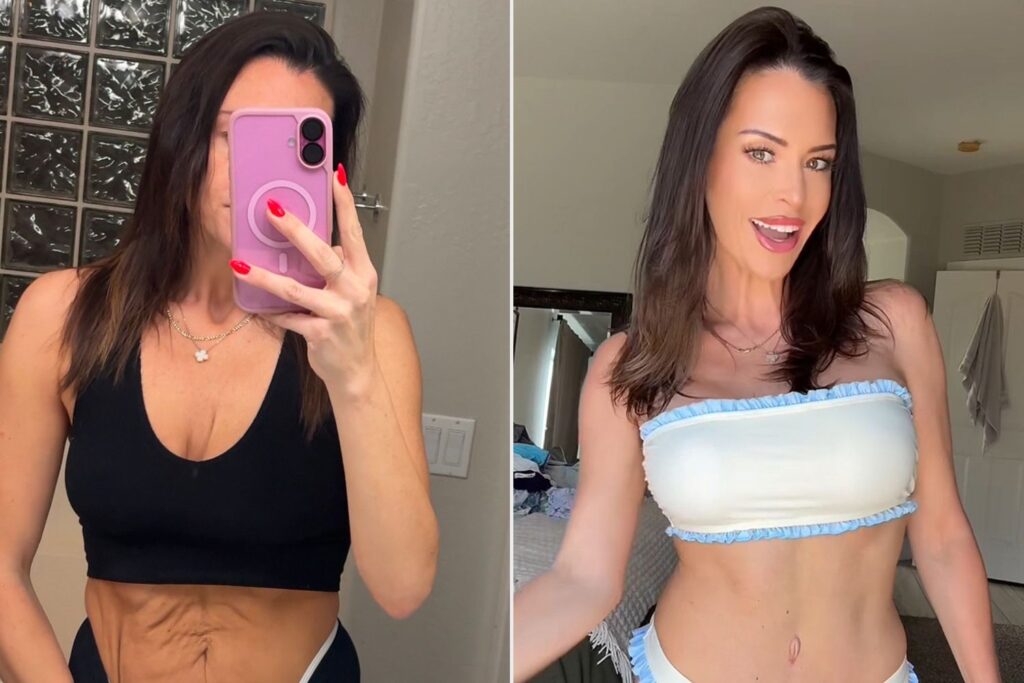 How Much Does a Mommy Makeover Cost in Mexico?